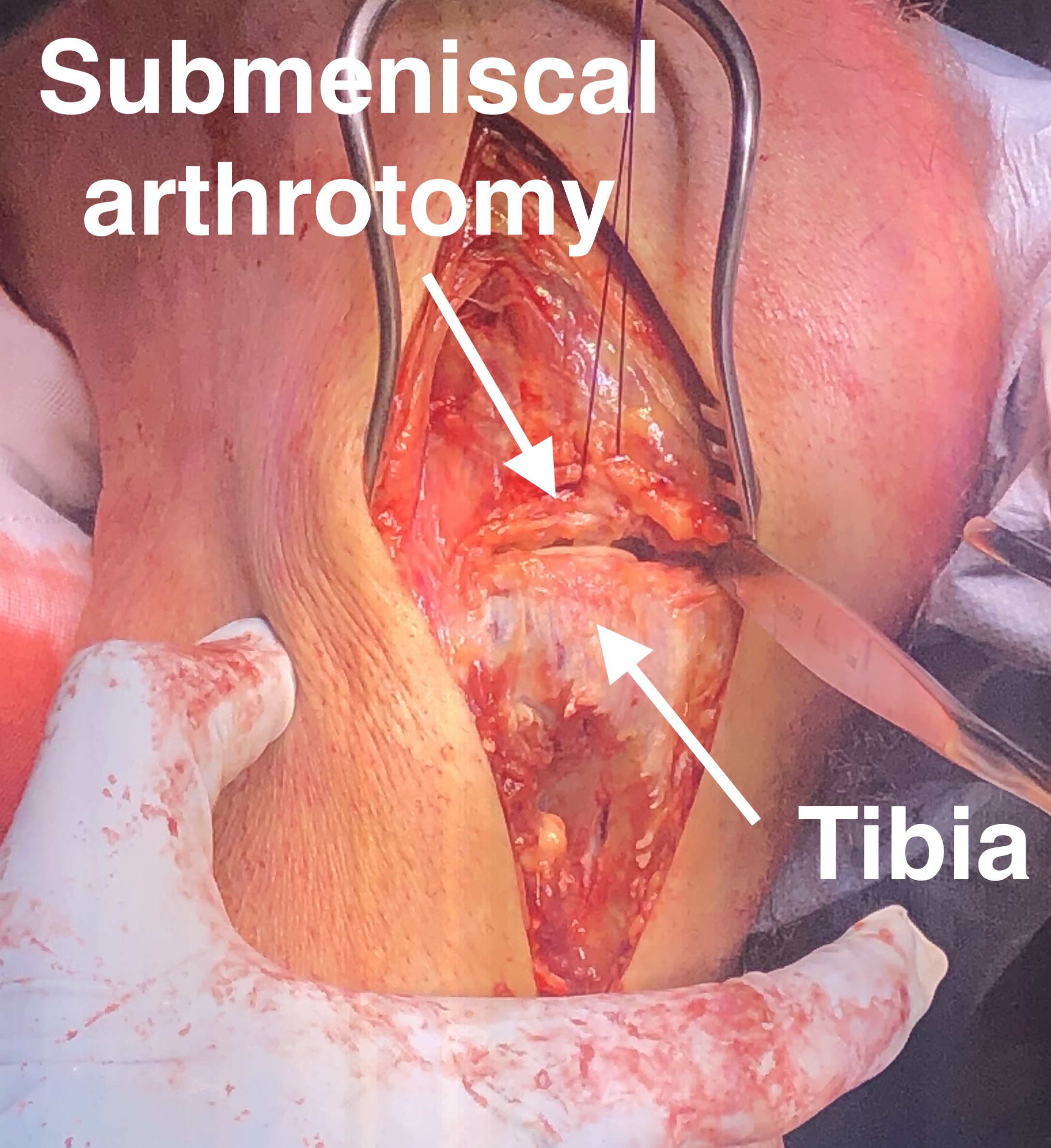 Tibia Anterolateral Approach 2